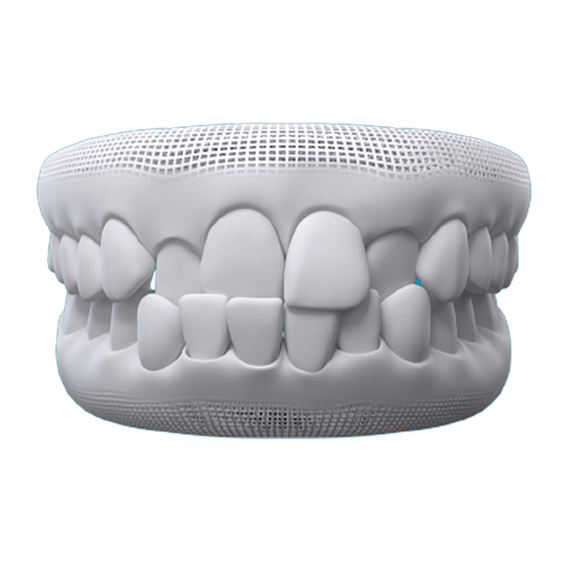 Crossbite
