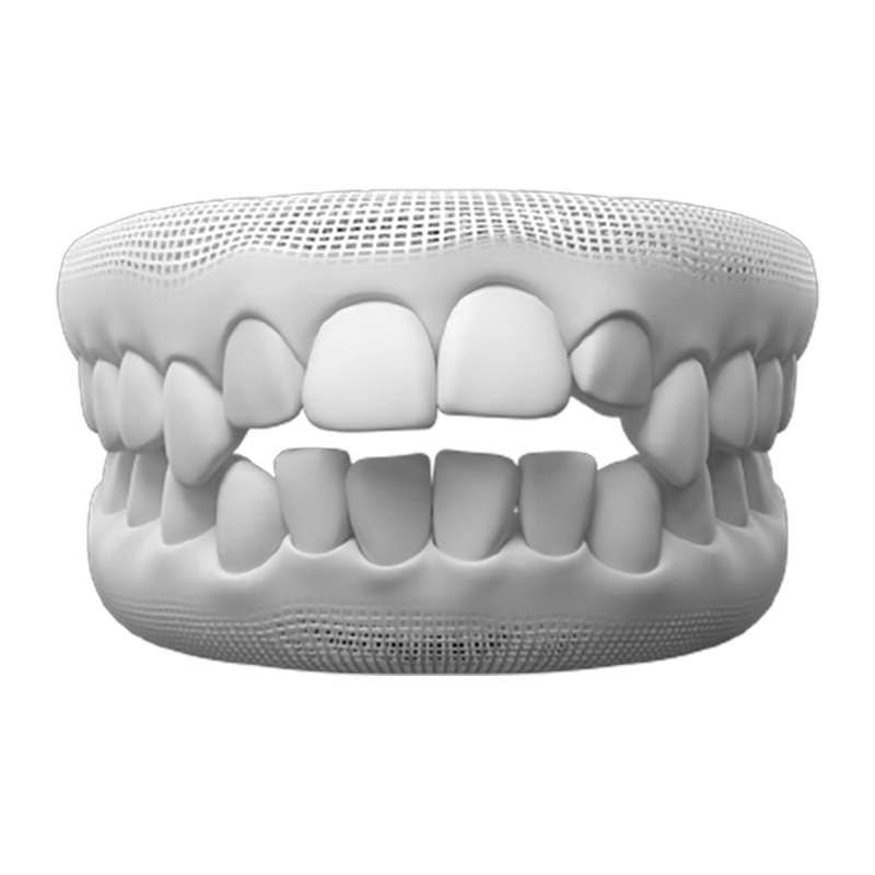 Open bite
