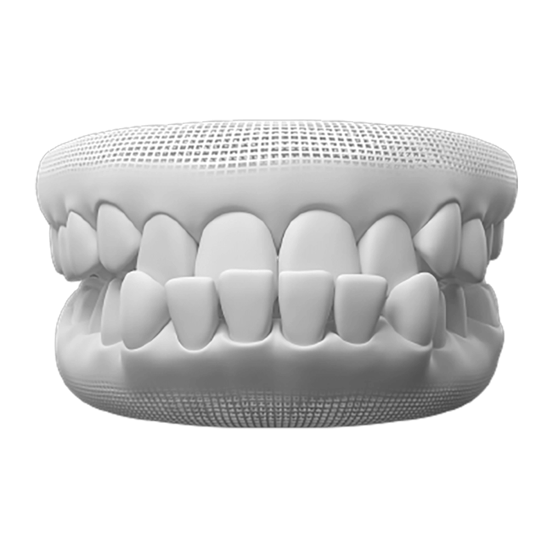 Underbite